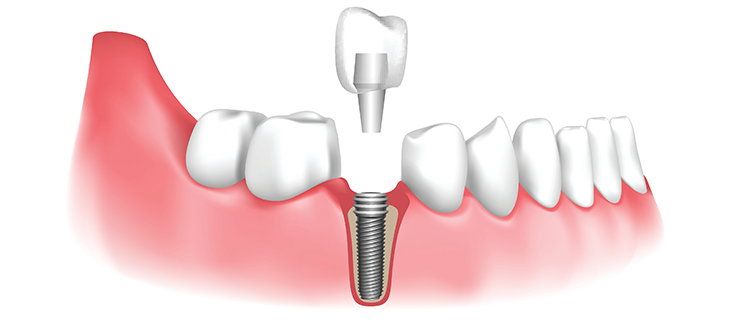 Can A Dental Implant Newcastle Improve Eating and Speaking
